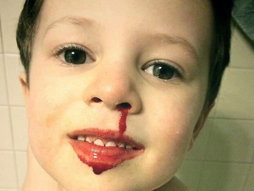¿Por qué el niño tiene sangre de la nariz? Causas de sangrado por la nariz, tratamiento