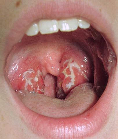 Revestimiento blanco en la lengua del adulto: causas y tratamiento