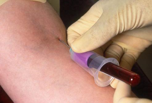 ¿Qué es un análisis de sangre clínico?