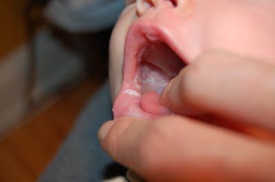 recubrimiento blanco en la lengua del bebé