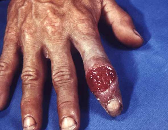 Sífilis: un síntoma de la enfermedad y el tratamiento